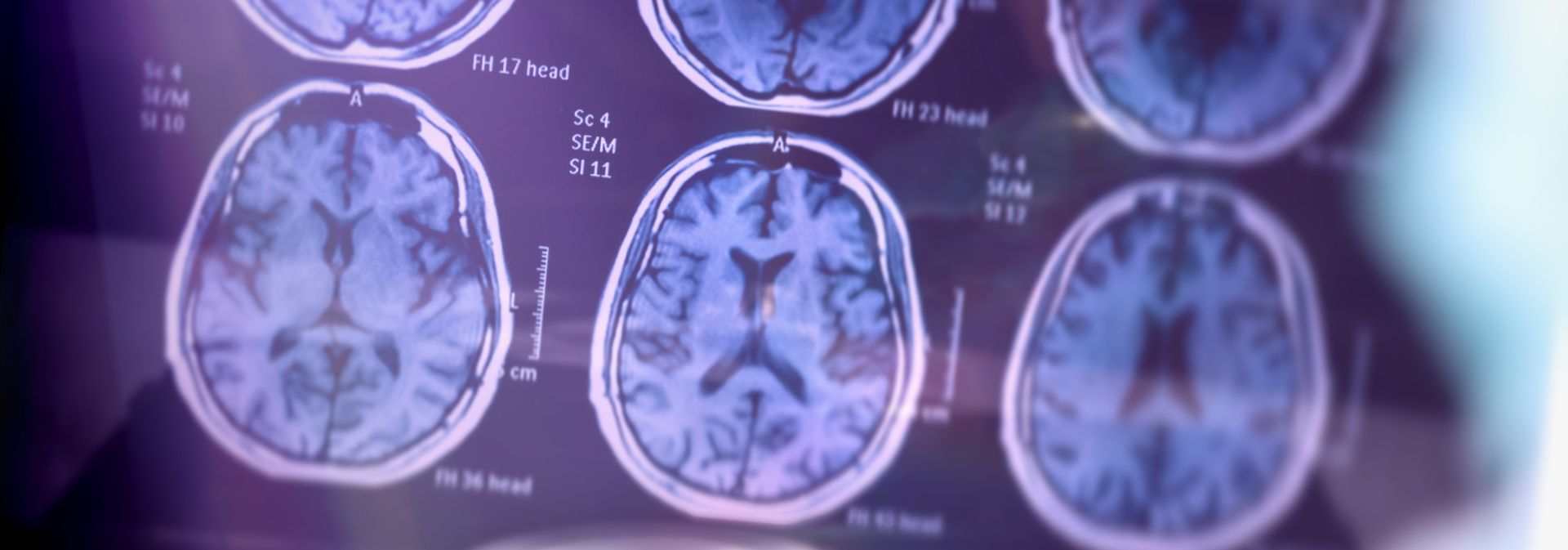 What You Need to Know about Lecanemab, the Potential New Alzheimer’s